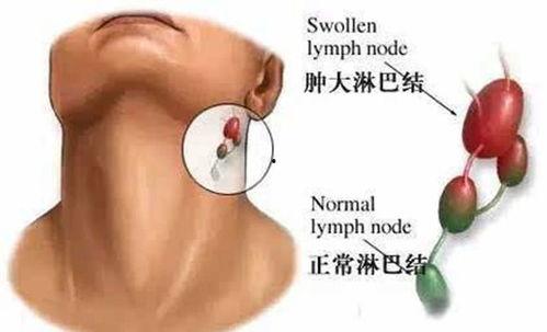 淋巴结瘤明星,揭秘明星身上的神秘“疙瘩”